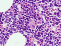 Refractory anemia with excess blasts -1 (RAEB-1) 7