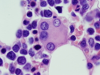 Refractory anemia with excess blasts -1 (RAEB-1) 8