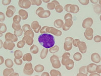 Refractory anemia with excess blasts-2 (RAEB-2) 1