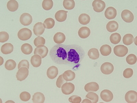 Refractory anemia with excess blasts-2 (RAEB-2) 2