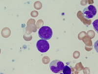 Refractory anemia with excess blasts-2 (RAEB-2) 3