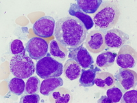 Refractory anemia with excess blasts-2 (RAEB-2) 4