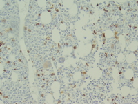 Refractory anemia with excess blasts-2 (RAEB-2) 6