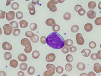 Acute myeloid leukemia with myelodysplasia-related changes 2