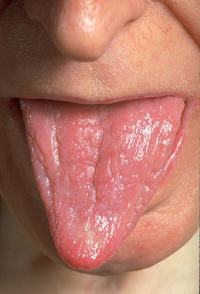 Iron-Deficiency-Anemia-other-manifestations