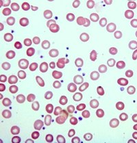 Iron Deficiency Anemia Moderate