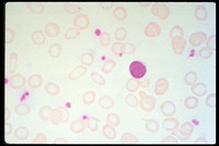 Iron-Deficiency-Anemia-Severe