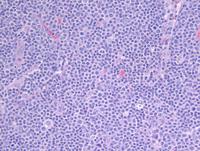 Node with areas of small lymphocytic lymphoma