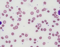 Irregularly contracted cells in oxidative hemolysis