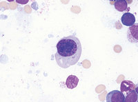 Megaloblastic erythroid precursor