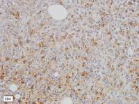 Immunostains - Blastic plasmacytoid dendritic cell neoplasm 1