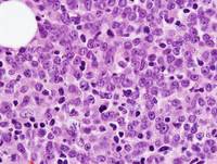 Core biopsy - Blastic plasmacytoid dendritic cell neoplasm 2