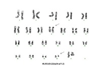 Cytogenetics ALL Ph+