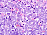 Relapsed-CD-34-ALL-Biopsy