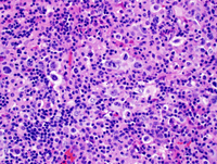 SLL with Richter's Syndrome (Hodgkin lymphoma type) 6