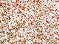 SLL with Richter's Syndrome (Hodgkin lymphoma type) 7