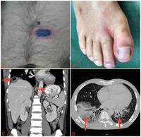 Disseminated Mucormycosis