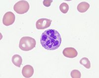 Hypersegmented neutrophil