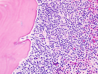 Follicular lymphoma involving the bone marrow 3