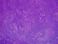 Nodular lymphocyte Predominant Hodgkin lymphoma 5