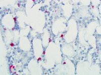 Refractory-Cytopenia-of-Childhood