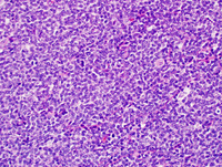 Mantle cell lymphoma 1