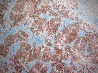 Follicular lymphoma, grade 3B 4