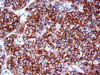 Follicular lymphoma, grade 3B 5