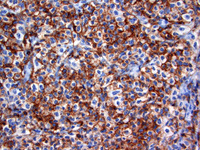 Follicular lymphoma, grade 3B 6