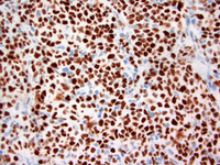 Follicular lymphoma, grade 3B 7