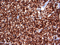 Follicular lymphoma, grade 3B 8