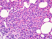 Hairy cell leukemia 1