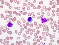 Hairy cell leukemia 2