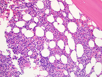 Hairy cell leukemia 5