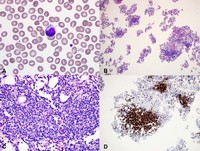 T-cell large granular lymphocytic leukemia