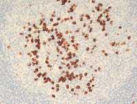 IgG4 related lymphadenopathy