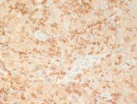 Lymphoepitheliod-cell-Lennerts-lymphoma