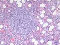 Plasmacytoid dendritic cells in marrow 1