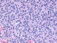 Plasmacytoid dendritic cells in marrow 2