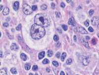 Reed Sternberg Cells 2