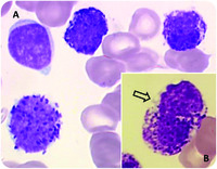 Acute basophilic leukemia