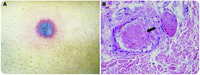 Disseminated fusariosis during acute myelogenous leukemia induction treatment