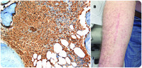 Darier’s sign in mastocytosis