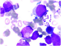 Bone marrow aspirate showing Penicillium marneffei