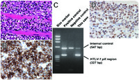 Extensive and destructive invasion of adult T-cell leukemia/lymphoma cells into systemic muscular tissues