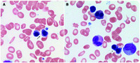 Building bridges to diagnosis and malignancy