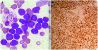 Diffuse large B-cell lymphoma in leukemic phase