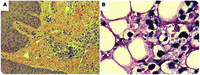 EBV-driven HIV-associated diffuse large B-cell lymphoma causing profound lactic acidosis