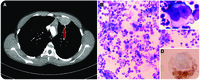 Nodular sclerosis Hodgkin lymphoma with classic Reed-Sternberg cells