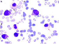 Auer rods in dysplastic granulocyte